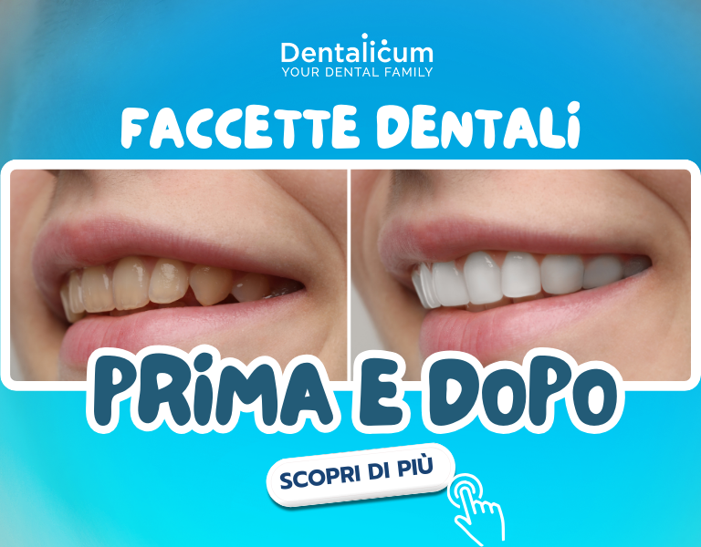 Prima e dopo faccette dentali in ceramica realizzate a Genova presso Dentalicum: confronto del sorriso del paziente prima del trattamento con denti con discromie e disallineati e dopo l’applicazione di faccette dentali estetiche, con risultato naturale, armonico e luminoso. Dentalicum | Your Dental Family |Genova