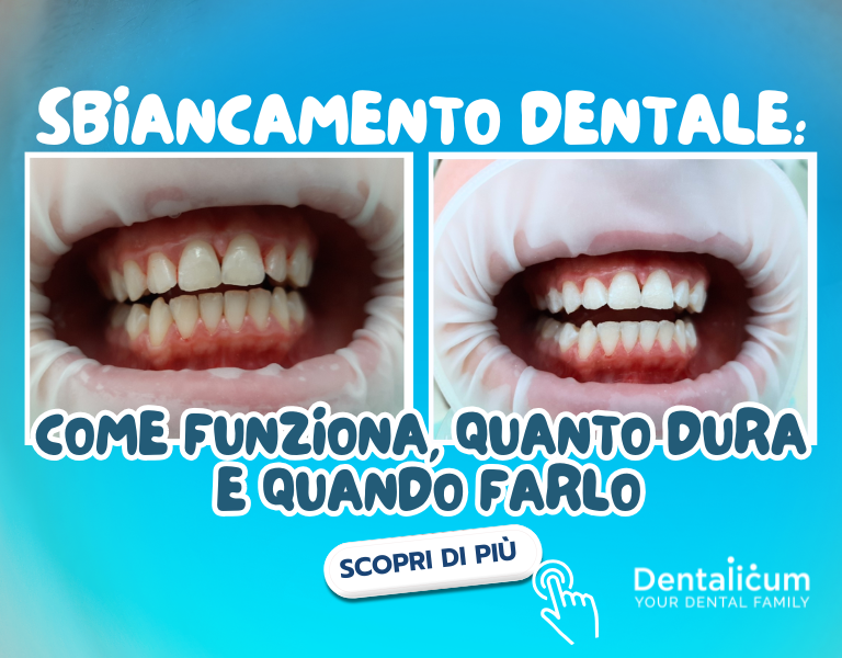 Prima e dopo sbiancamento dentale professionale con miglioramento del colore dei denti.